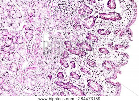 Histology Of Human Tissue, Show Gastric Mucosa Intestinal Metaplasia As Seen Under The Microscope, 1