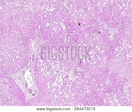 Histology Of Human Tissue, Show Liver Fatty Degeneration As Seen Under The Microscope, 10x Zoom