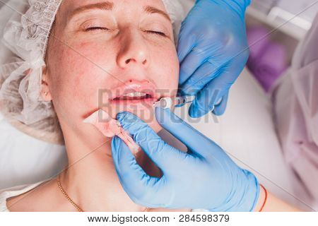 The Doctor Cosmetologist Makes Lip Augmentation Procedure Of A Beautiful Woman In A Beauty Salon.cos