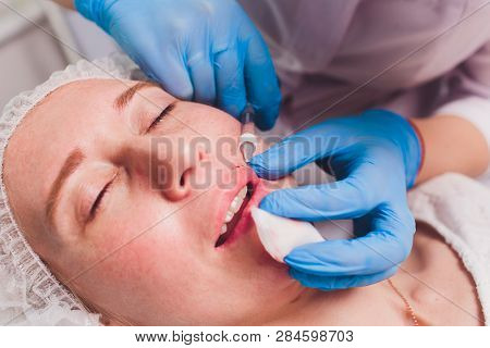 The Doctor Cosmetologist Makes Lip Augmentation Procedure Of A Beautiful Woman In A Beauty Salon.cos