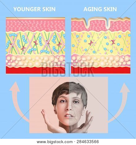 The Younger Skin And Aging Skin. Elastin And Collagen. A Diagram Of Young And Old Face Showing The D