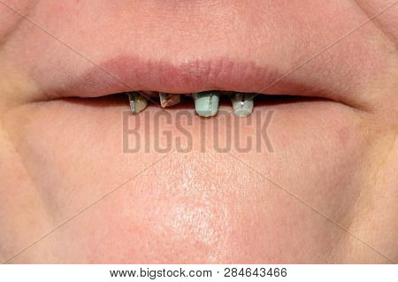 Close-up Of A Womans Face With Rotten And Dying Teeth