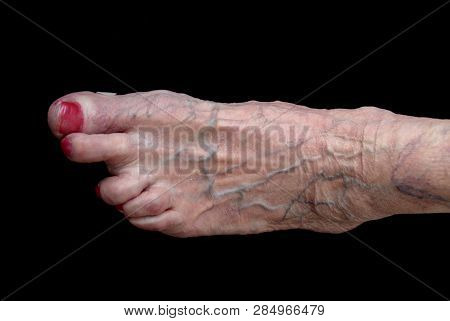 Foot With Arthritis Reumatica (ra) At Women. Women 85 Years Old And Have Had Reumatica In 45 Years