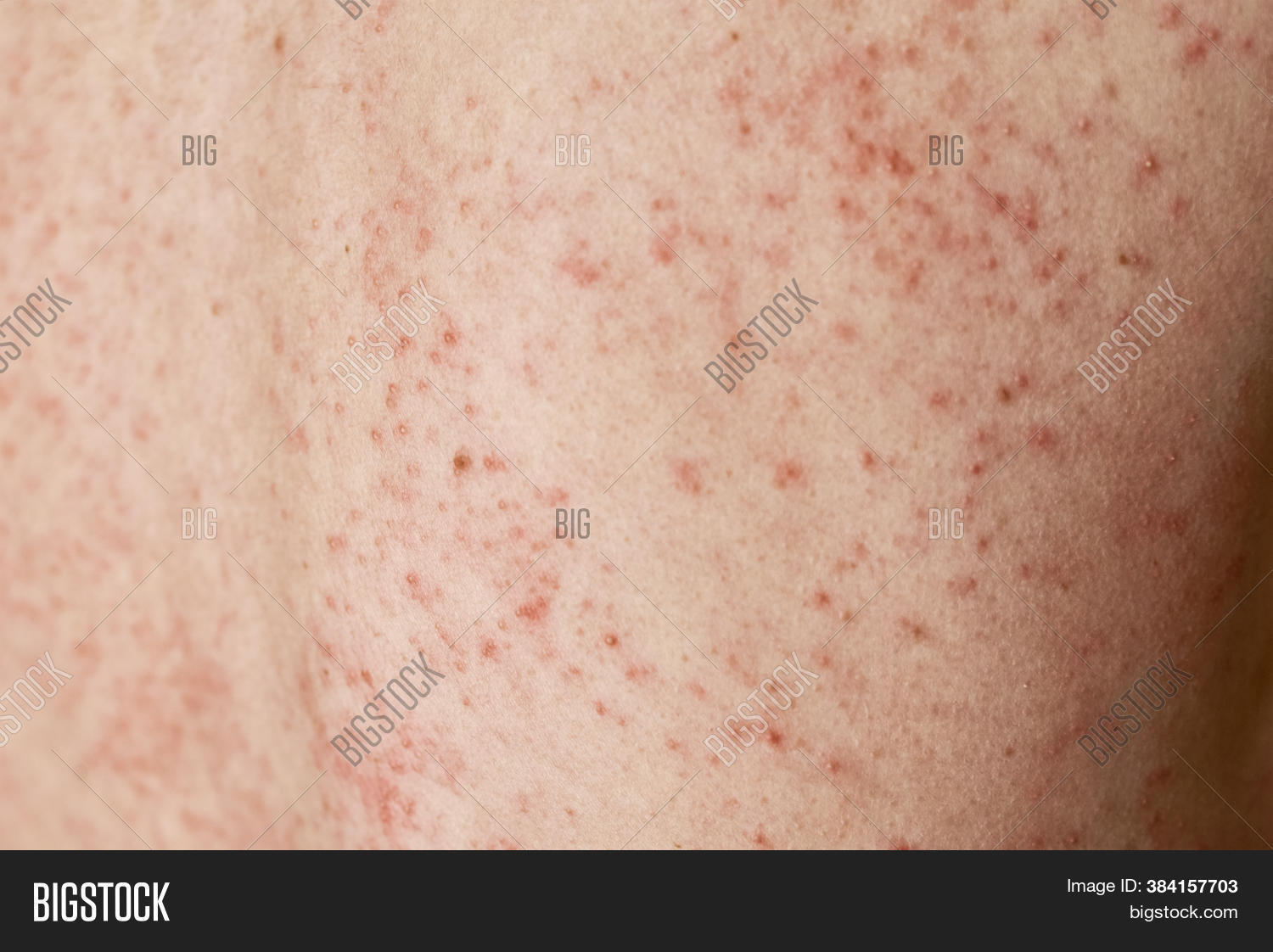 Allergic Rash On Skin Image & Photo (Free Trial) | Bigstock