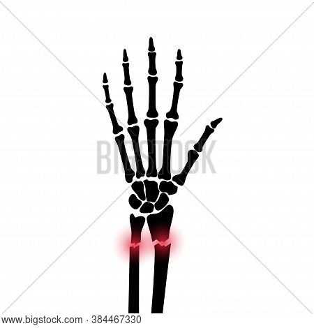 X Ray Of Arm Fracture With Red Pain Or Inflammation Points. Broken Hand With Inner Closed Radius Typ