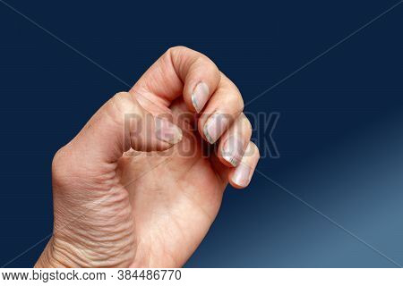 Close-up Of Female Caucasian Hand With Dirty Brittle Nails, Broken Nails On A Blue Background. Peeli