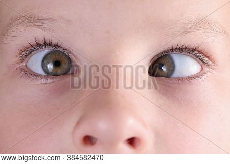 Childs Face With Squint And Freckles On Nose. Strabismus In Children Causes And Treatment Concept