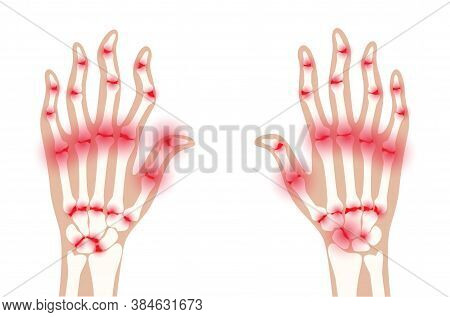 Pain And Inflammation In Hand On X Ray. Rheumatoid Arthritis Symptom On Human Joints And Bones. Skel