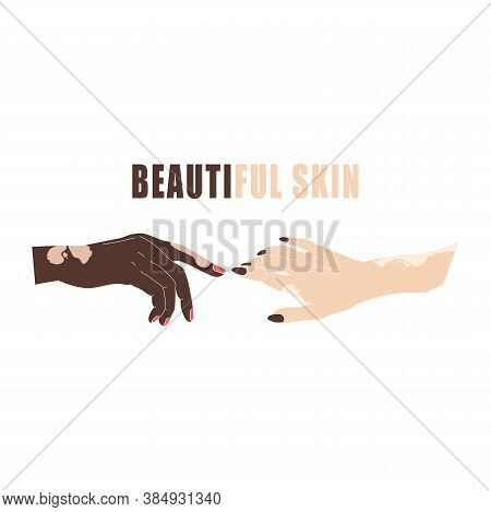 Hands With Age Spots Or Vitiligo Isolated Vector. Hand Gestures With Genetic Skin Disease. Womans Ha