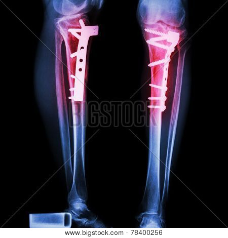 Fracture Tibia(leg Bone)