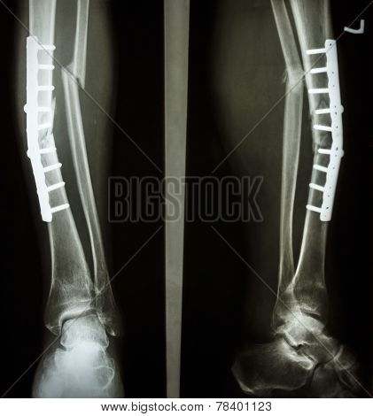 Fracture Shaft Of Tibia And Fibula