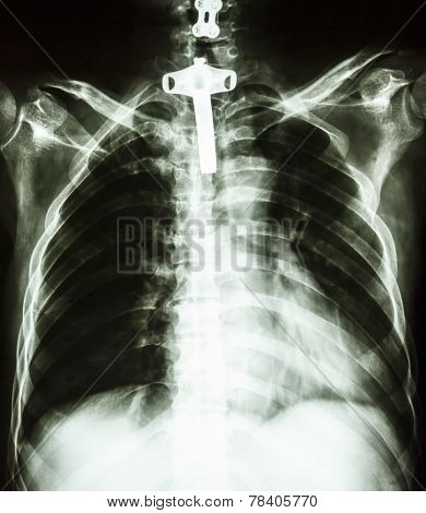 Human Chest With Tracheotomy Tube
