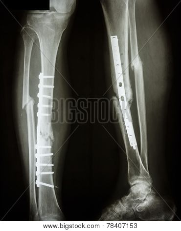 Fracture Shaft Of Tibia And Fibula