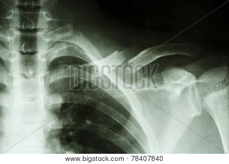 Fracture Left Clavicle
