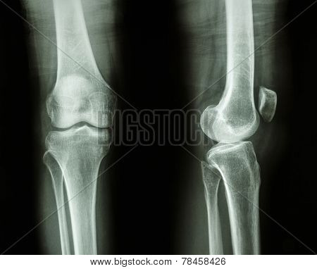 Normal Human's Knee