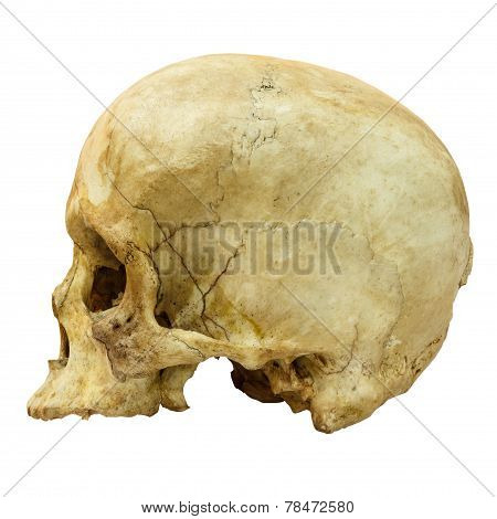 Human Skull Fracture (side)  (mongoloid,asian) On Isolated Background