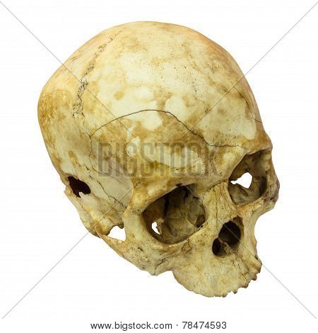 Human Skull Fracture ( top side , apex ) ( Mongoloid , Asian ) on isolated background