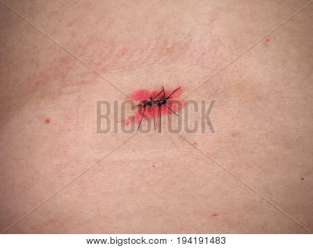 Surgical Wound With Stitches And Iodine Tincture