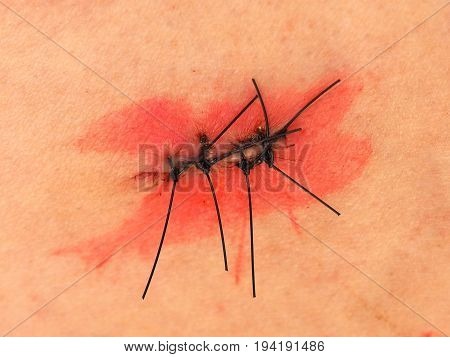 Surgical Wound With Stitches And Iodine Tincture