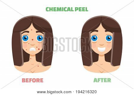 Chemical peeling before and after. Vector illustration