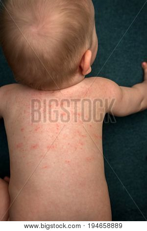 Allergies pimples on the baby's skin. Food allergy. Skin diseases symptoms.