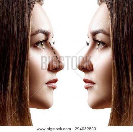 Young Woman In Profile Before And After Rhinoplasty. Over White Background.