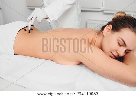 Patient During Leech Therapy, Alternative Hirudotherapy, Blood Purification