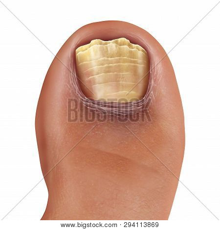 Infected Fungal Toe Nail And Feet Infection Or Onychomycosisor Tinea Unguium As Toenail Foot Disease
