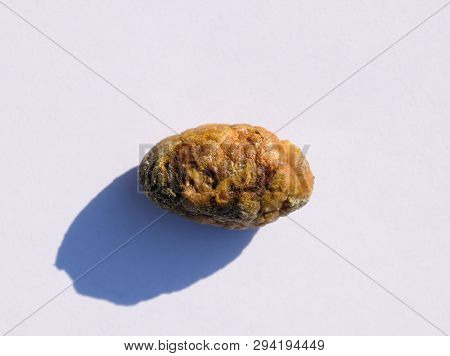 Stone Of The Gallbladder. The Result Of Gallstones. A Calculus Of Heterogeneous Composition.
