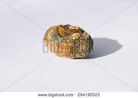 Stone Of The Gallbladder. The Result Of Gallstones. A Calculus Of Heterogeneous Composition.