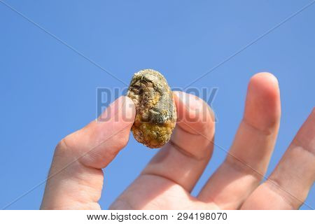 Stone Of The Gallbladder. The Result Of Gallstones. A Calculus Of Heterogeneous Composition Against 