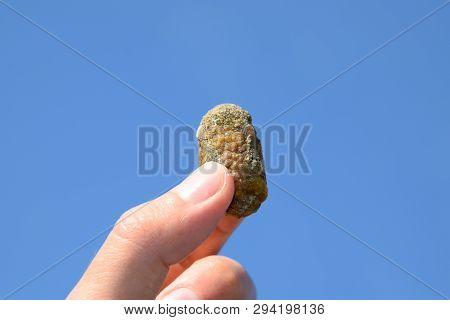 Stone Of The Gallbladder. The Result Of Gallstones. A Calculus Of Heterogeneous Composition Against 