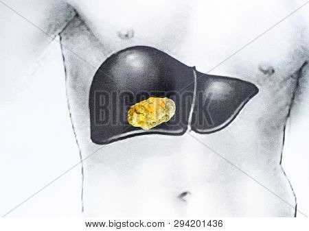 Stone In The Liver, A Schematic Image, A Large Gallstone, The Result Of Gallstones.