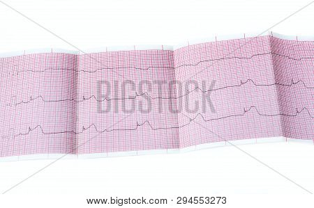 Ecg With Acute Period Of Macrofocal Myocardial Infarction, Av Block Ii Degree Type Mobitts I And Rhy