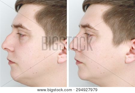 A Man At The Reception At The Plastic Surgeon. Before Nose Surgery, Rhinoplasty