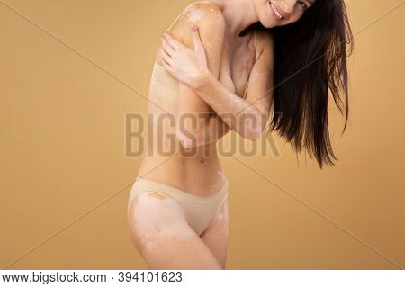 Love Your Body. Portrait Of Skinny Young Lady With Vitiligo Skin Disorder Posing In Underwear On Bei