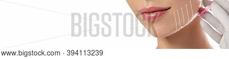 Threadlifting On Beautiful Female Face Close Up. Procedure Mesothreads Lifting Skin Isolated On Whit