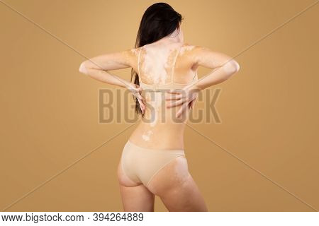 Vitiligo Skin. Rear View Of Young Woman With Body Depigmentation Posing In Underwear Over Beige Back