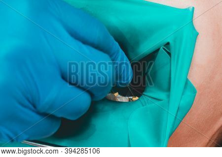 The Dentist Treats The Patients Tooth With A Rubber Dam, Drill, Mirror.