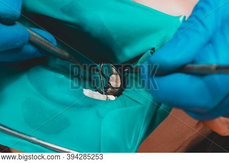 Restoration Of A Chewing Surface By Means Of Material For Filling With Photopolymer By Means Of The 