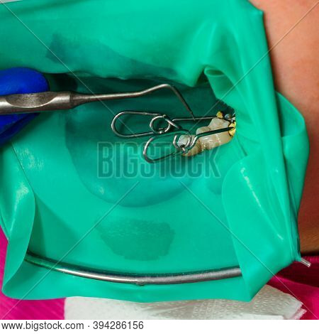Dental Restoration And Polymerization Of Tooth Composite Materials, The Doctor Conducts Sterile Work