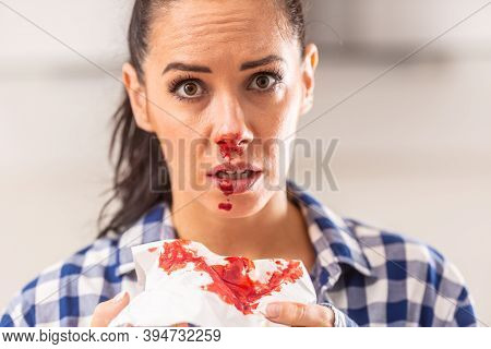 Young Female With Bleeding Nose Has Blood All Over Tissue, Her Nose And Mouth.