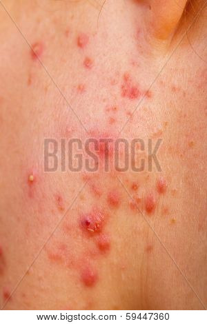Acne Skin