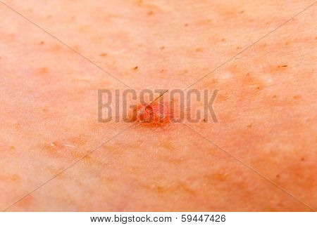 Acne Skin