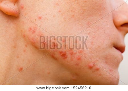 Acne Skin
