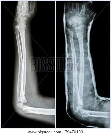 Fracture Shaft Of Ulnar Bone ( Forearm Bone )