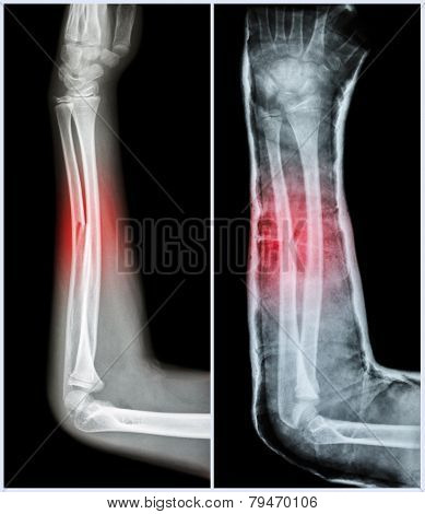 Fracture Shaft Of Ulnar Bone ( Forearm Bone )