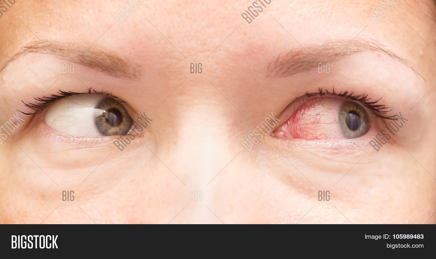 Irritated Eye Image & Photo (Free Trial) Bigstock