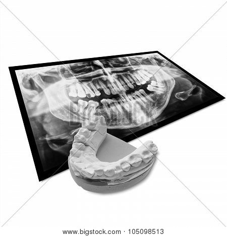 Black And White Xray Of Teeth With Positive Teeth Cast