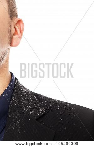 Close Up From A Man With A Dandruff Problem